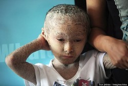 Pan Xianhang, Bocah Ikan yang Sekujur Tubuhnya Ditumbuhi Sisik