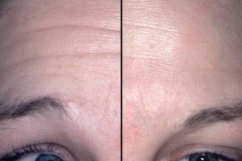 Before After, Beginilah Bentuk Wajah Setelah Terapi Botox Hingga Laser