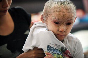 Inilah Pan Xianhang, Berjuluk Bocah Ikan karena Kulitnya Penuh Sisik