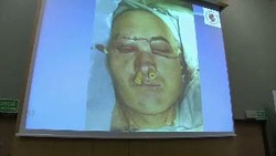 Pria ini Kembali Berwajah Setelah Menjalani Transplantasi