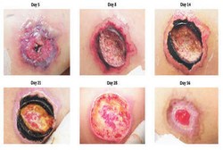 Gigitan Laba-laba Berubah Menjadi Luka Terbuka dan Bengkak 2 Bulan