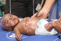Tubuh Bayi 3 Bulan Ini Bisa Terbakar Sendiri, Diduga karena Sakit Langka