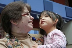  Bocah Idap Sindrom Langka Ini Diadopsi Wanita dengan Penyakit yang Sama