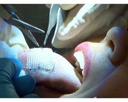 2 Wanita Coba Diet Ekstrem Jahit Lidah dengan Koyo Plastik, Ini Hasilnya