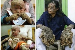 Benda Aneh yang Tumbuh di Tubuh Manusia, Terumbu Karang Hingga Pohon Cemara