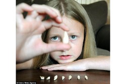 Jatuh Saat Mendaki Papan Kayu, Bocah Ini Kehilangan 8 Giginya