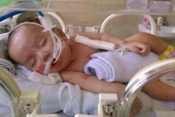 Penyakit Langka, Tubuh Bayi Janisha Membiru dan Tak Bisa Bernapas