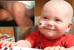 Kena Kanker, Kulit Bocah Ini Melepuh Jika Terpapar Sinar Matahari