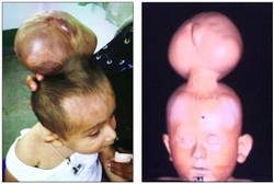 Bayi Berkepala 2 di India Jalani Operasi Pemisahan Kepala