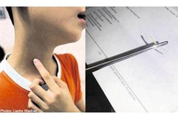 Duh! Tulang Ikan Sepanjang 5 Cm Tersangkut di Leher Bocah Ini 