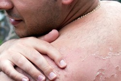 Studi: Pria Lebih Gampang Mati karena Kanker Kulit daripada Wanita