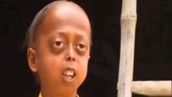 Terkena Penyakit, Anak Usia 14 Tahun Tampak Berusia 110 Tahun