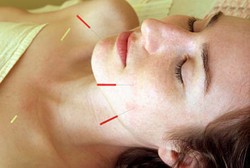 Ditinggal Dokter, Pasien Akupuntur Cabut Jarum dari Tubuh Sendiri