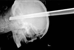 Pria ini Selamat Usai Kepala Tertancap Kaki Kursi Sedalam 10 Cm