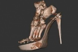 Hii, Ngerinya Foto Kaki yang Rusak Karena Sering Pakai High Heels