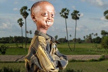 Ali Hussain Khan, Remaja 14 Tahun yang Tubuhnya Tampak Berumur 110 Tahun