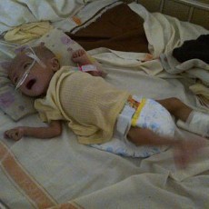 Dewi dari Cijantung Derita Gizi Buruk, Usia 7 Bulan Berat 2,7 Kg