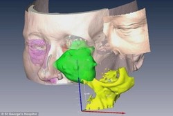  Dengan 3D Scanner, Wajah Bagian Kiri Ann yang Rusak Bisa Diperbaiki