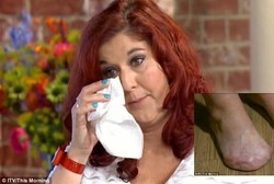 Dokter Lupa Beri Antibiotik, Wanita Ini Kehilangan Jari Kaki Pasca Operasi