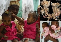 Kembar Siam Hussaina dan Hassana Berhasil Dipisah dalam Operasi 18 Jam