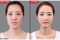 Operasi Rahang Memang Bikin Cantik, Tapi Nyawa Bisa Jadi Taruhan