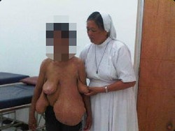 Tolong! Ibu di Nias Ini Bertumor Berat hingga Payudara Putus