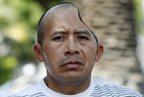 5 Orang ini masih hidup meski tengkorak kepalanya tinggal setengah