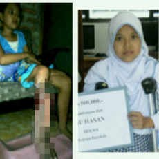 Luka Membusuk, Kaki Pelajar SMP Bojonegoro Ini Terancam Diamputasi