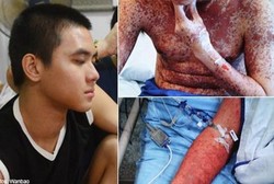 Kena Penyakit Langka, Kulit Remaja Ini Seperti Hangus Terbakar