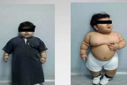 Balita 2 Tahun Ini Manusia Termuda yang Jalani Operasi Potong Lambung