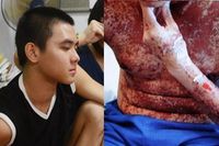 Chen De En, Remaja yang Kulitnya Hangus Terbakar karena Penyakit Langka