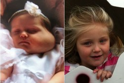 Tanda Lahir Sebesar Jeruk di Pipi Bocah Ini Kempes Berkat Obat Jantung