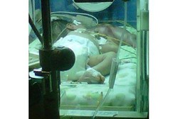 Kembar Siam Tak Lazim Muncul dari Mulut Bayi Lain, Apa Sebabnya?