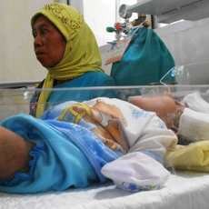 Sejak Lahir Bayi Tanpa Tempurung Kepala Tak Pernah Menangis