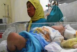 Bayi Tanpa Tempurung Kepala Dirawat Intensif di RSU Situbondo