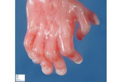 Mengapa Ada Orang yang Lahir dengan Jari Ekstra?