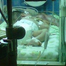 Bakal Janin Itu Menempel di Lidah dan Rongga Mulut Bayi Ginan