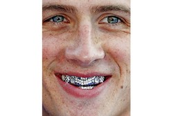 Pasang Behel Bertahta Berlian Diklaim Sembuhkan Kerusakan Gigi dan Tulang