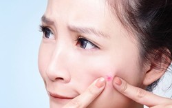 Jerawat Selalu Muncul Lagi? Atasi dengan Konsumsi Brokoli dan Alpukat