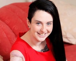 Tubuh Penuh Bekas Luka Bakar, Wanita Ini Sukses Menang Kontes Kecantikan