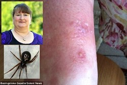 Digigit Laba-laba, Kaki Wanita 54 Tahun Ini Terancam Diamputasi