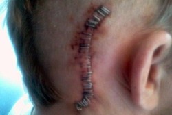 Akhirnya Pria Ini Bisa Cium Istri Setelah Teflon Ditanam di Otak