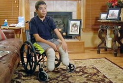 Tak Mau Menderita karena Gangguan Otot Langka, Remaja Ini Amputasi Kaki