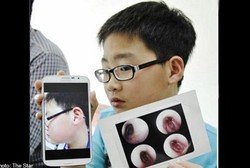 Ditampar Guru, Bocah 11 Tahun Kehilangan Pendengaran di Telinga Kiri