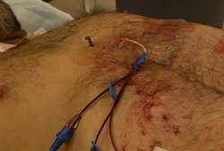 Tak Sengaja, Tukang Kayu Ini Tertancap Paku Berjarak 9 Cm dari Jantung