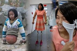 Sepasang Kaki Palsu Baru untuk Gadis Bola Basket