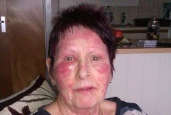 Gara-gara Krim Anti-kerut, Wajah Perempuan Ini Melepuh