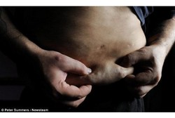 Sakit Langka, di Tubuh Pria Ini Muncul Ratus Benjolan Lemak Menyakitkan