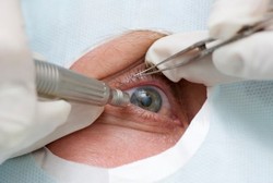 Katarak Memang Bisa Bikin Buta, Tapi Bukan Buta Permanen