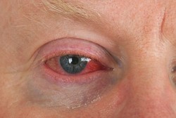 Mata Anda Merah? Jangan Kucek Kalau Tidak Mau Bahaya